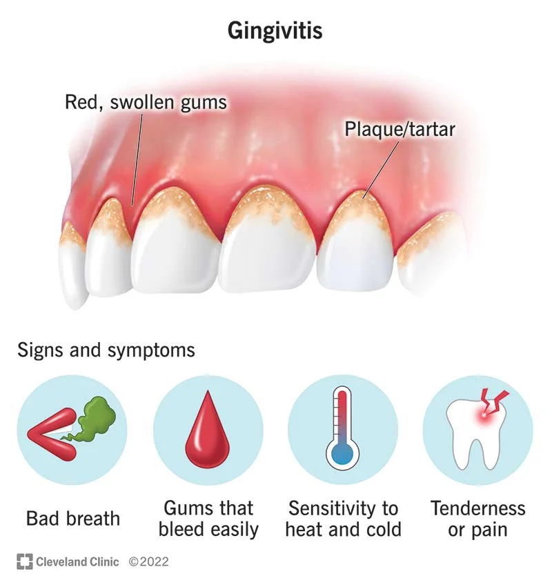 Dental Scaling (Professional Teeth Cleaning)